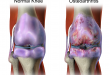 Osteoarthritis