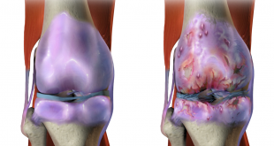 Osteoarthritis