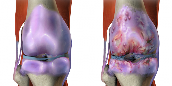 Osteoarthritis